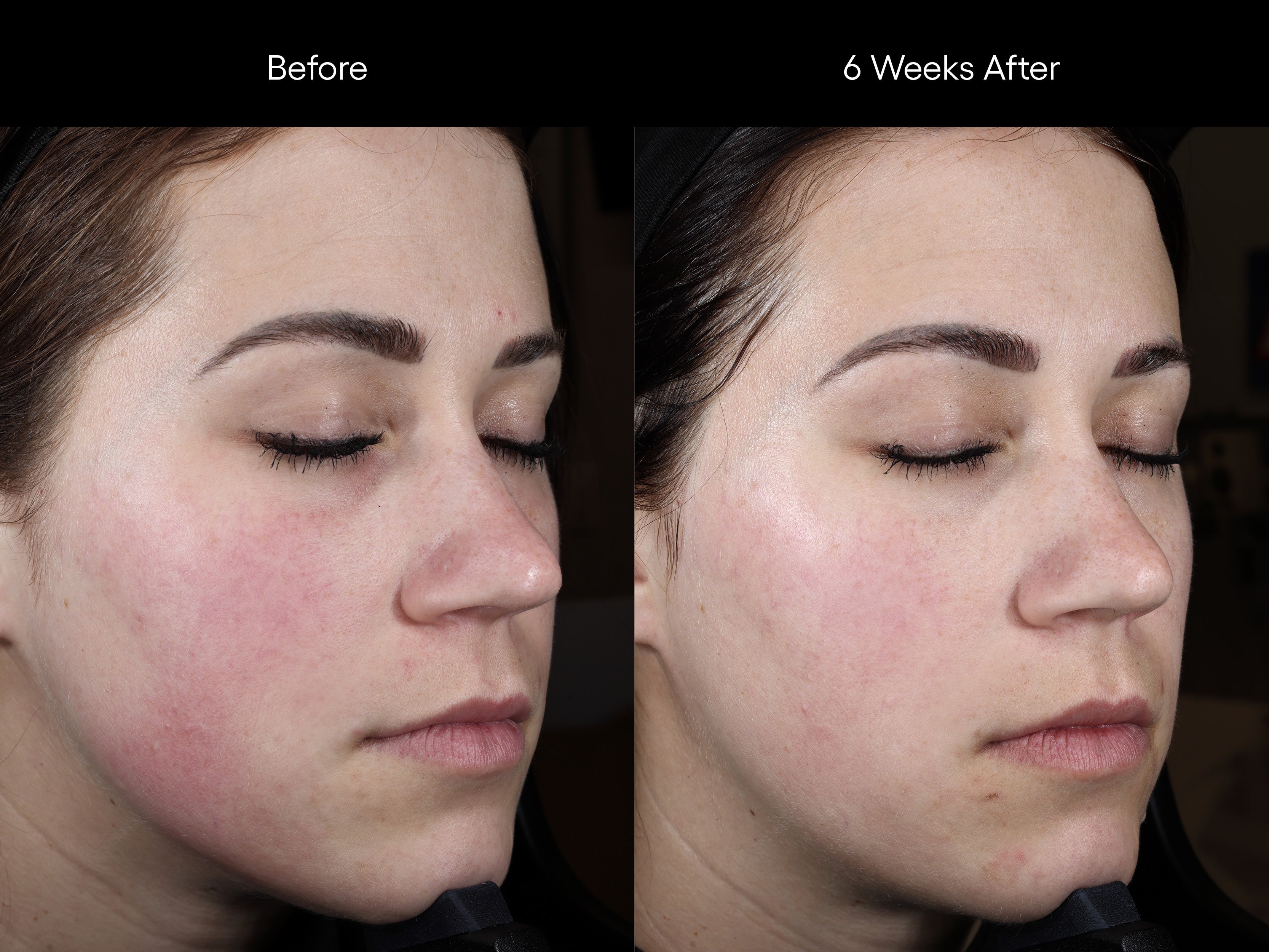 Before and after image of a woman at 6 weeks progress