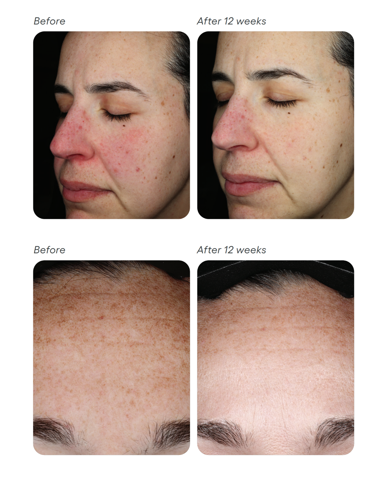 Before and after comparison of skin treatment on various parts of the face.