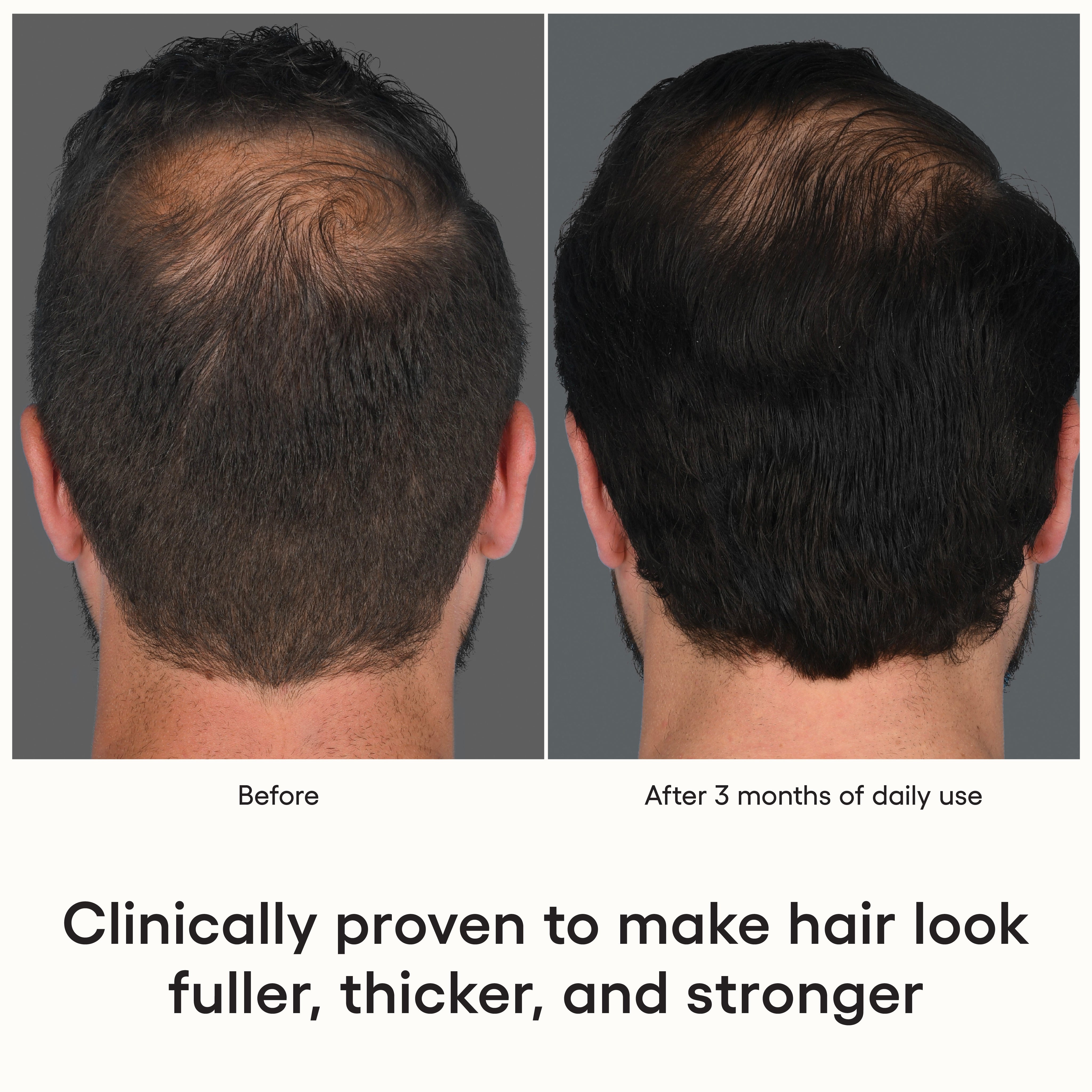 Before and after comparison of hair growth treatment showing a man's head with visible hair loss on the left and visibly fuller hair on the right after 3 months of use.