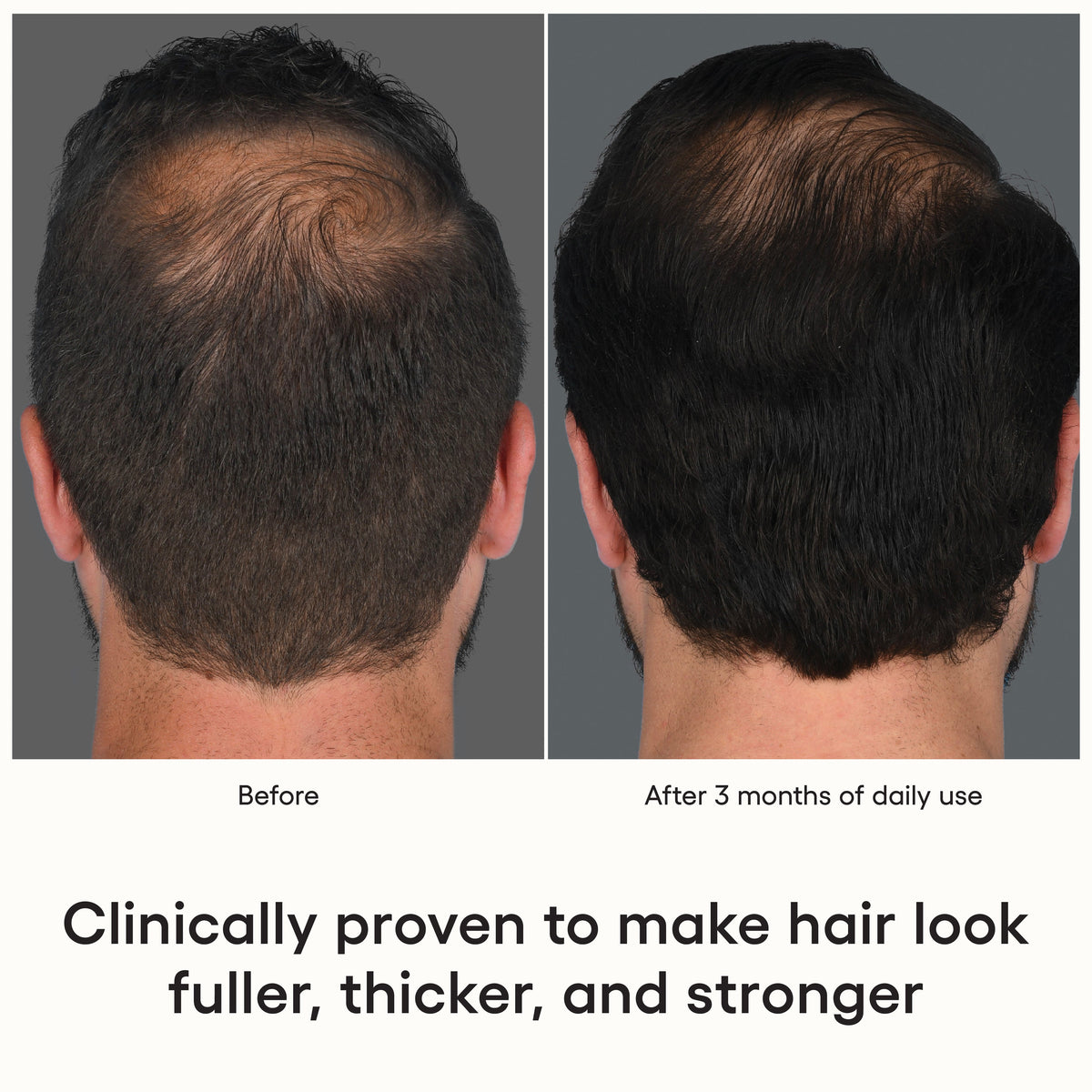Before and after comparison of hair growth treatment showing a man's head with visible hair loss on the left and visibly fuller hair on the right after 3 months of use.